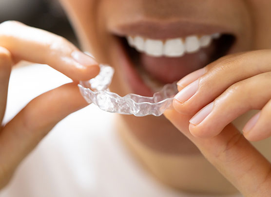 Woman inserting a clear aligner