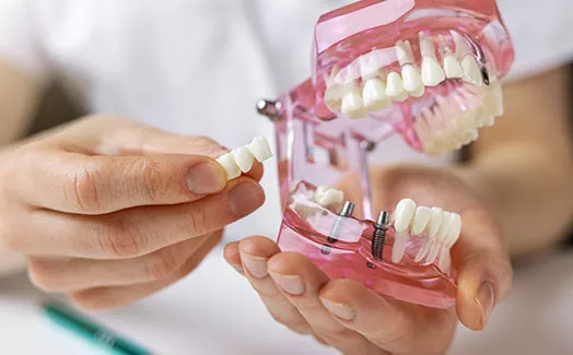 Model of dental bridge